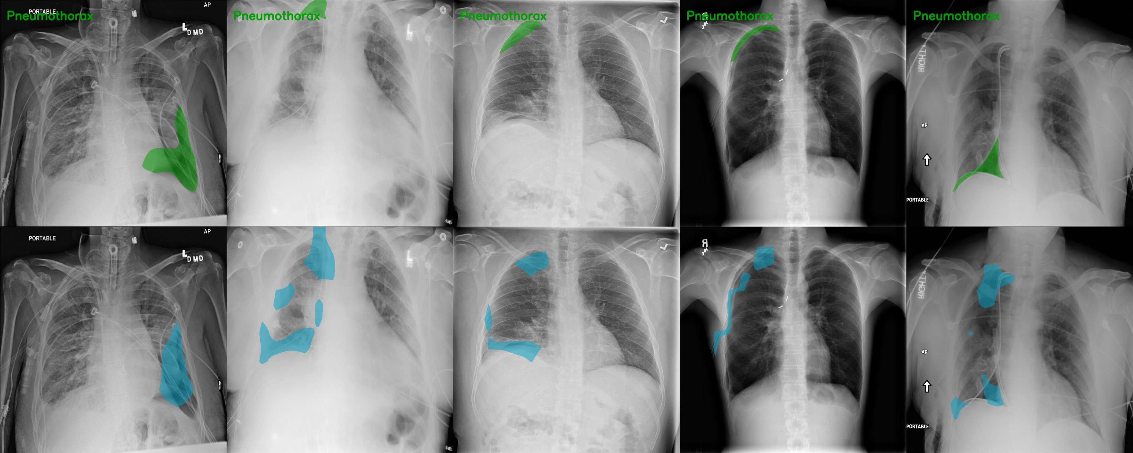 SIIM-ACR pneumothorax segmentation, ground truth above prediction.
