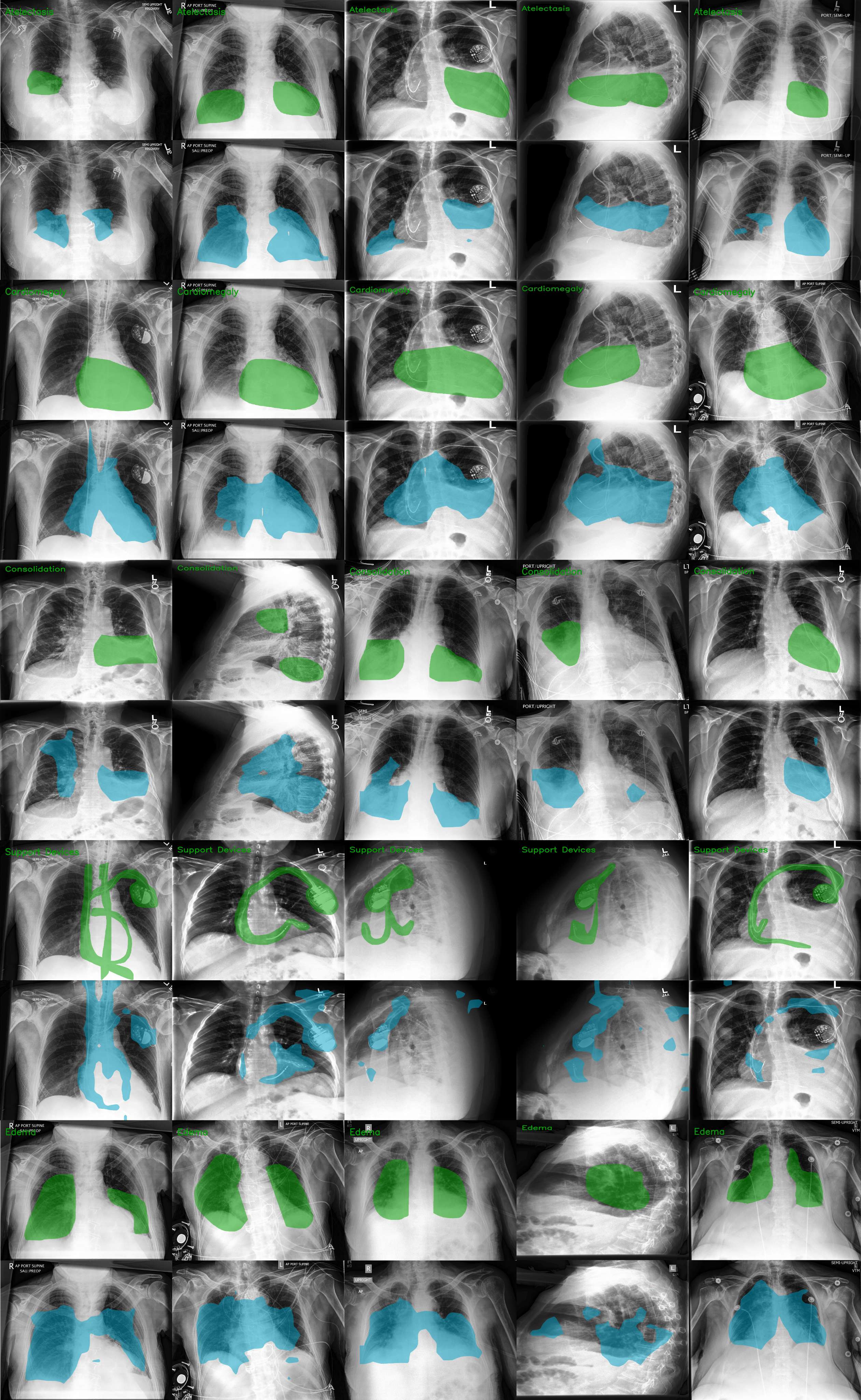 CheXlocalize segmentation results for the first five pathology classes.